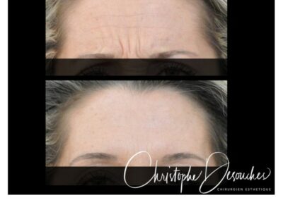 Botulinum toxin injections in the forehead - Erase expression lines