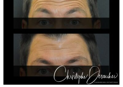 Iniezione di Botox negli uomini sulla fronte