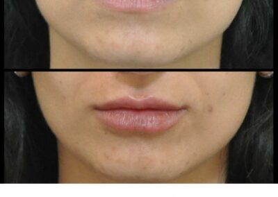 Lip augmentation by injection of Hyaluronic Acid: before / after