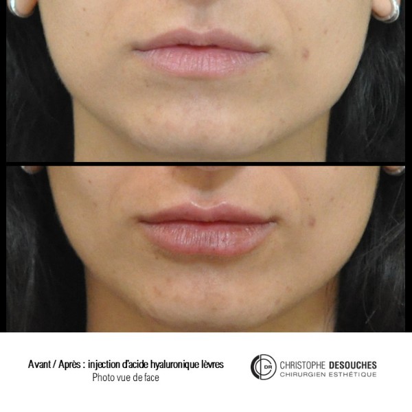 Lip augmentation by injection of Hyaluronic Acid: before / after