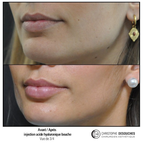 Lip augmentation / lip augmentation by injection of hyaluronic acid