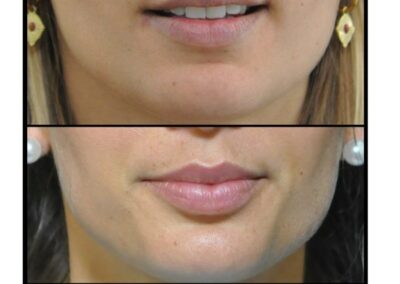 Increase in lip volume by injection of hyaluronic acid
