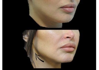 Redraw the shape of the jaw with hyaluronic acid