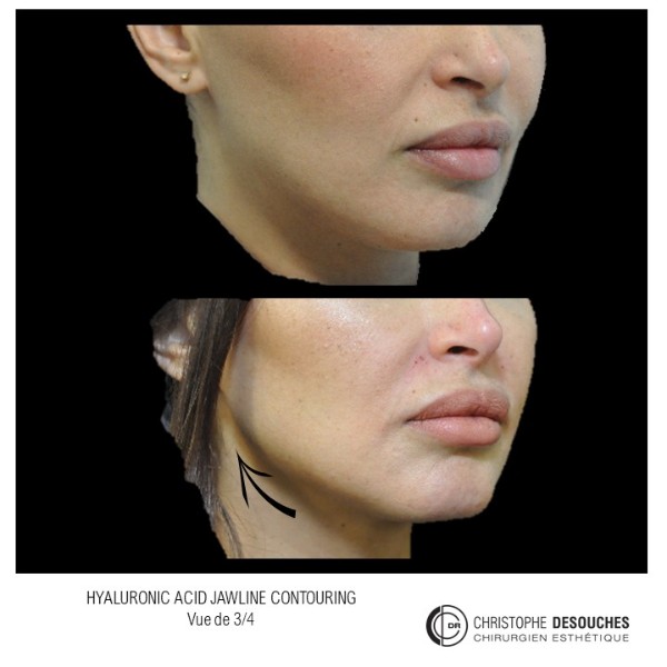 Redraw the shape of the jaw with hyaluronic acid