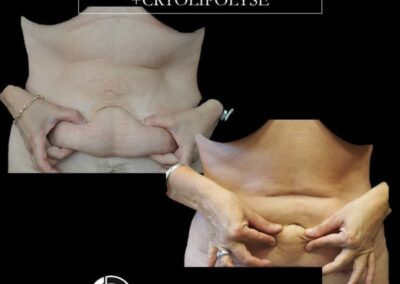 DERMOLIPECTOMIA ABDOMINAL Y CRIOTERAPIA