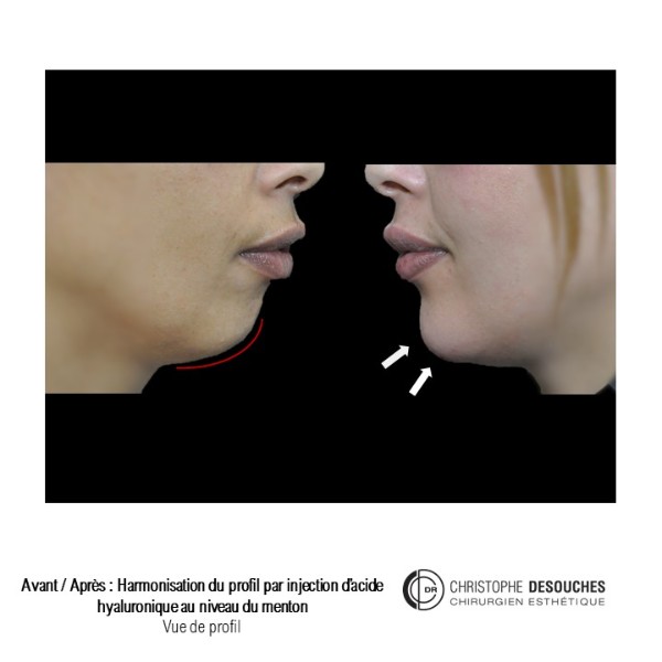 Genioplastie médicale : Harmonisation du profil par injection d&rsquo;acide hyaluronique au niveau du menton