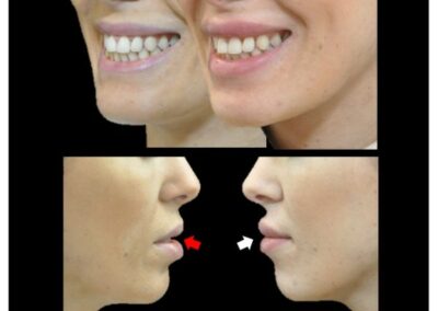 Correzione del sorriso gommoso o "sorriso gommoso" mediante iniezioni di acido ialuronico