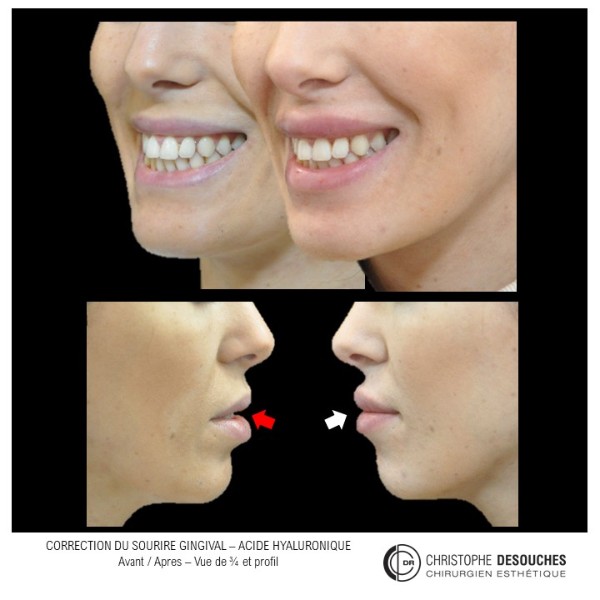 Correction of the gingival smile or "gummy smile" by injections of hyaluronic acid