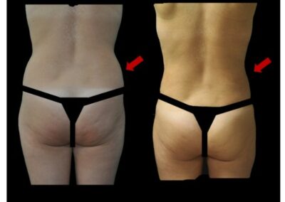 Resultado de liposucción para lipofilling mamario