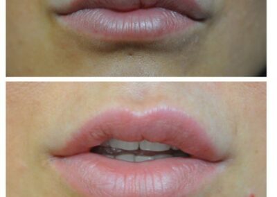 Ialuronidasi + Reiniezione di acido ialuronico nelle labbra