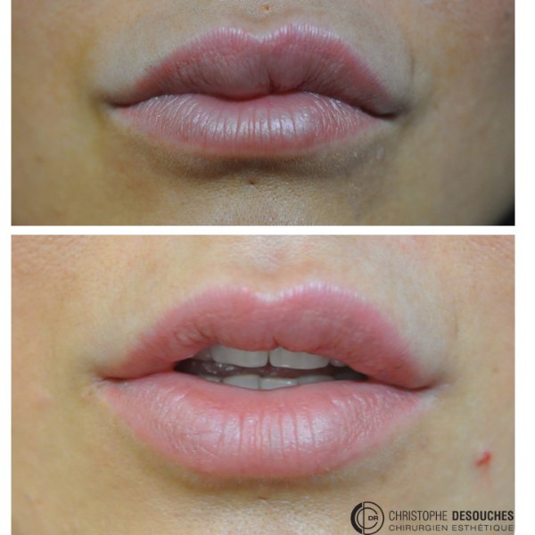 Hyaluronidase + Réinjection acide hyaluronique au niveau des lèvres