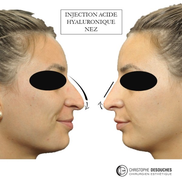 Profiloplastie par injection d’acide hyaluronique