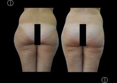 LIPOSUCCION OF THE HIPS AND BUTTOCKS
