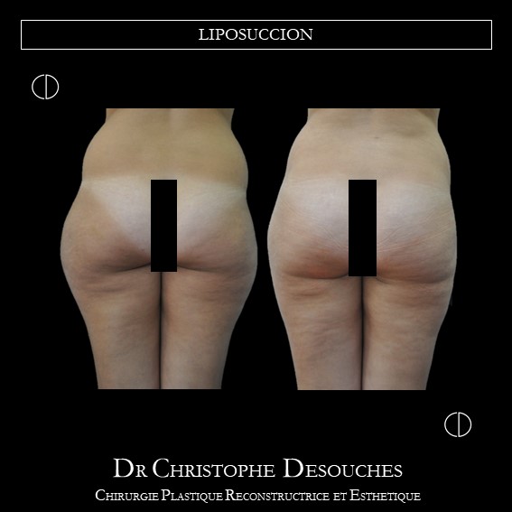 LIPOSUCCION DES HANCHES ET FESSES