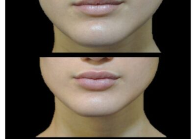 Lips augmentation