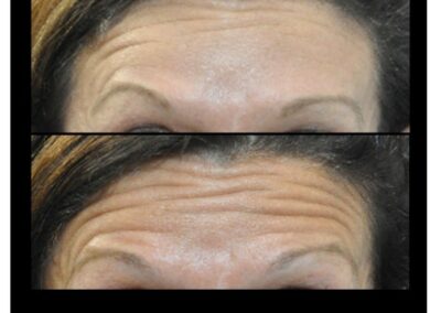 Tossina botulinica chiamata anche botox