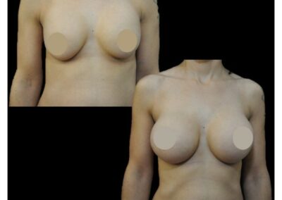 Breast augmentation by prosthesis