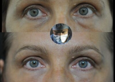 Injection d’Acide hyaluronique pour harmoniser le regard sans chirurgie