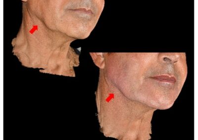 Inyección de ácido hialurónico mandibular para hombres