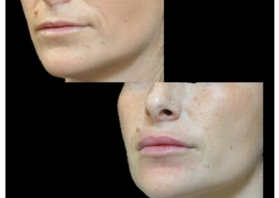 Aumento delle labbra mediante iniezione di Acido Ialuronico: prima/dopo
