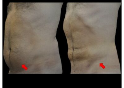 LIPOSUCCIÓN ABDOMINAL