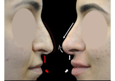 Point rhinoplasty associated with fillers