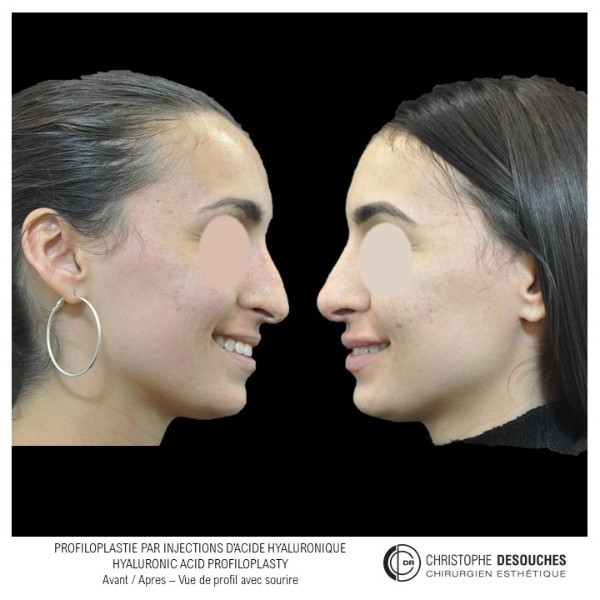 Profiloplastie et rhinoplastie de la pointe