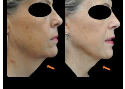 lifting cervico-facciale o liposuzione del collo