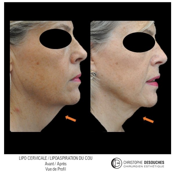 cervico-facial lifting or neck liposuction