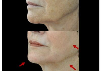 peeling facciale