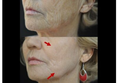I benefici del peeling per il viso