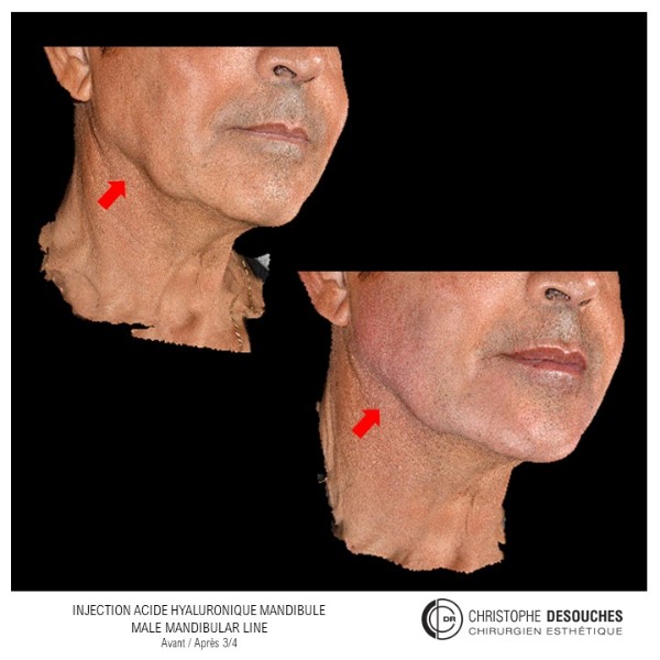 Mandible hyaluronic acid injection for men