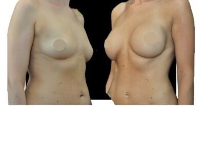 Aumento de senos con prótesis