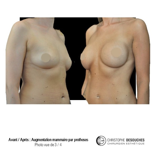 Breast augmentation by prosthesis