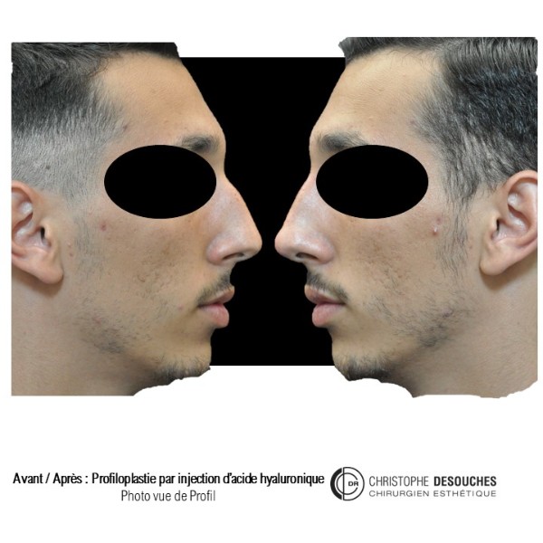 Profiloplasty by injection of hyaluronic acid into the nose