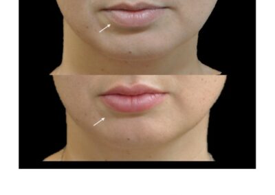 Aumento delle labbra/aumento delle labbra mediante iniezione di acido ialuronico