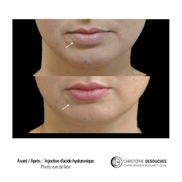 Lip augmentation / lip augmentation by injection of hyaluronic acid