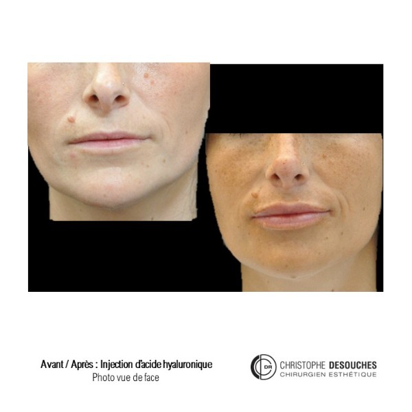 Lip augmentation / lip augmentation by injection of hyaluronic acid