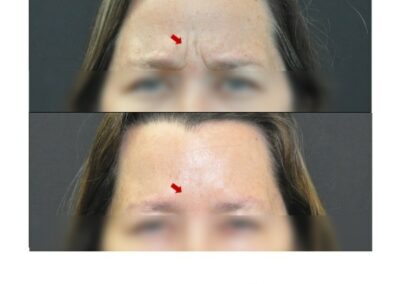 Botox