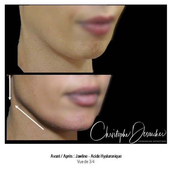 Jawline contouring or how to redraw the jaw with hyaluronic acid