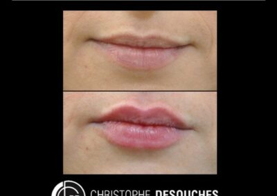 Augmentation des lèvres par injection d’Acide Hyaluronique