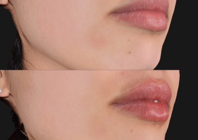 Aumento de labios mediante inyección de Ácido Hialurónico