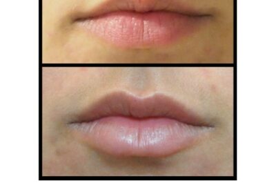 Aumento de labios / aumento de labios mediante inyección de ácido hialurónico