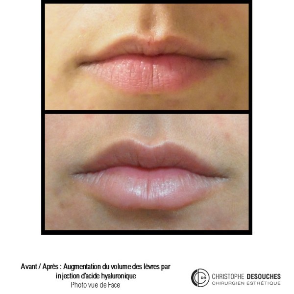 Lip augmentation / lip augmentation by injection of hyaluronic acid