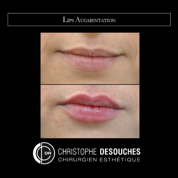 Lip augmentation by injection of Hyaluronic Acid