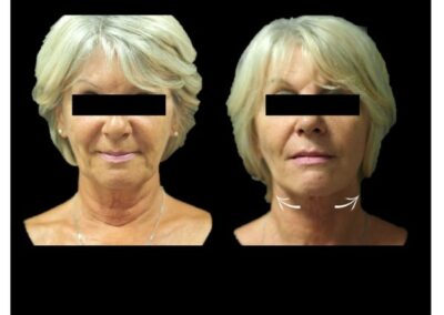 lifting cervico-facciale