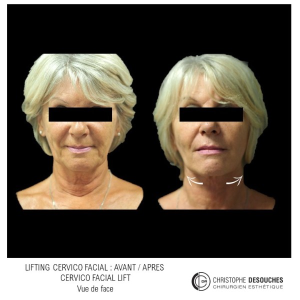 cervico-facial lifting