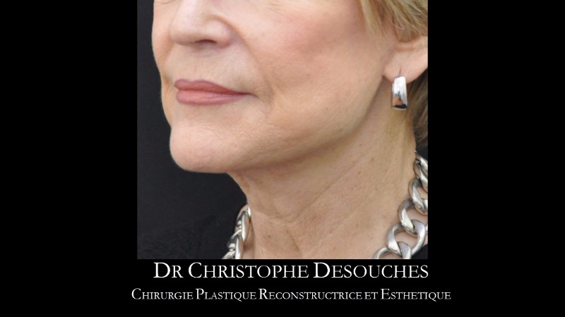 lifting cervico-facial