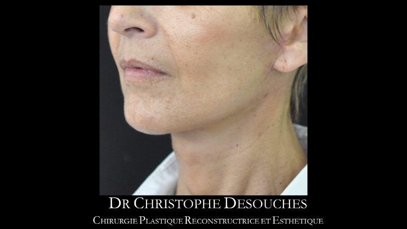 lifting cervico-facial