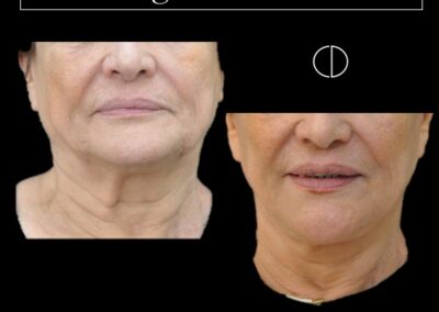 lifting cervico-facciale